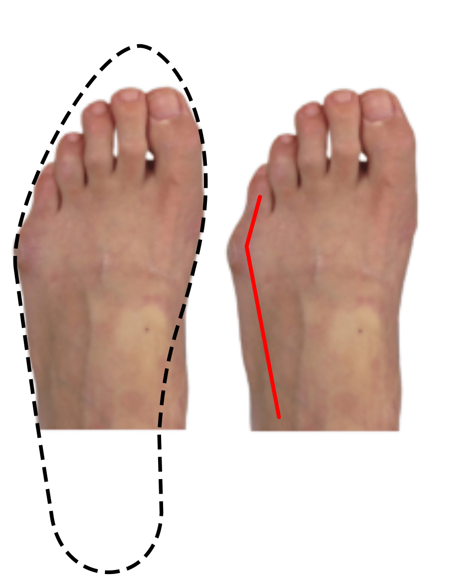 Tailors bunions, bunions, and the footwear shape that causes them. 
